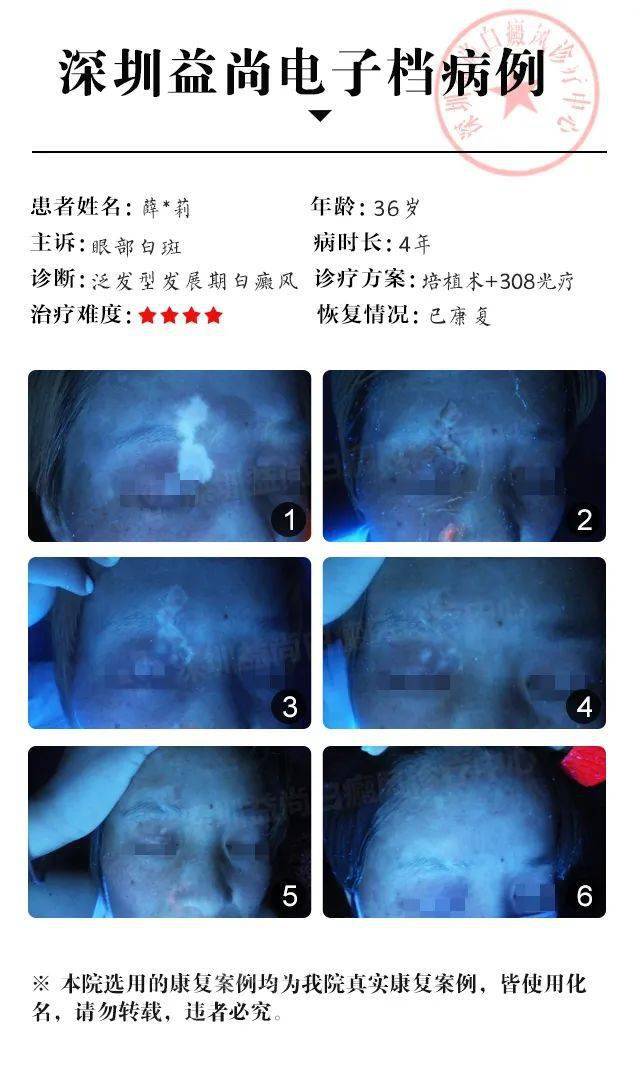 溫州白癜風(fēng)治療新技術(shù)探索與突破